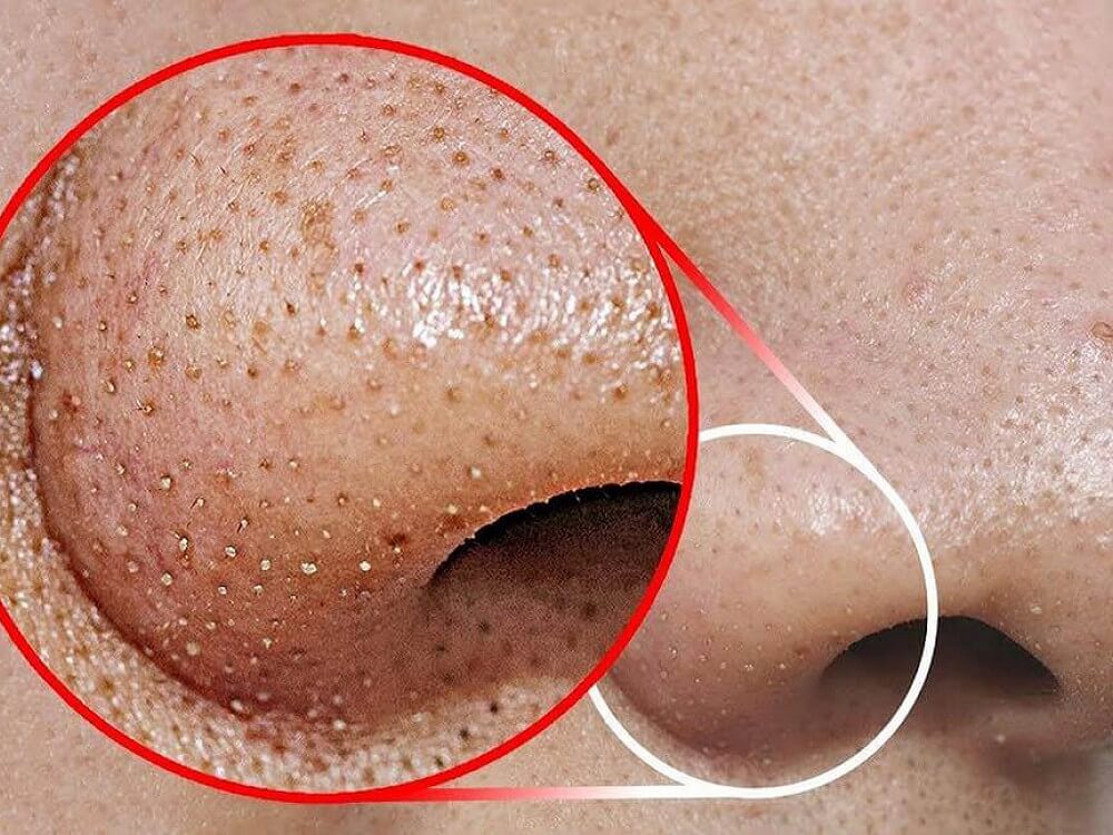 THE EXTRACTION FACIAL!