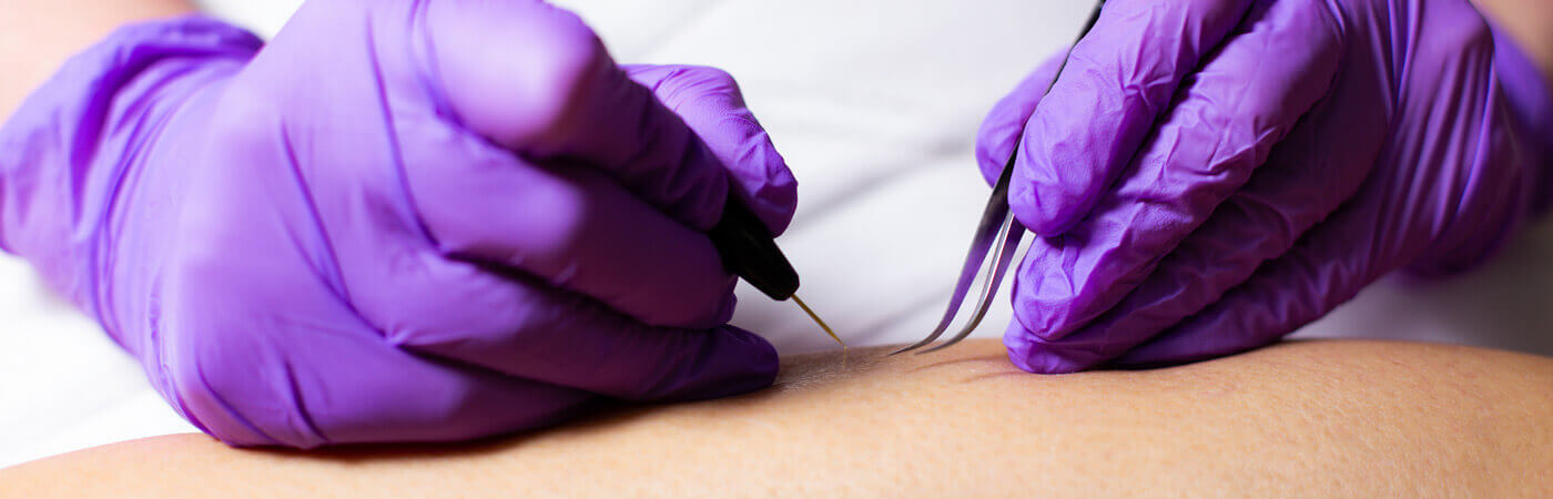 Advanced Skin Lesion Removal