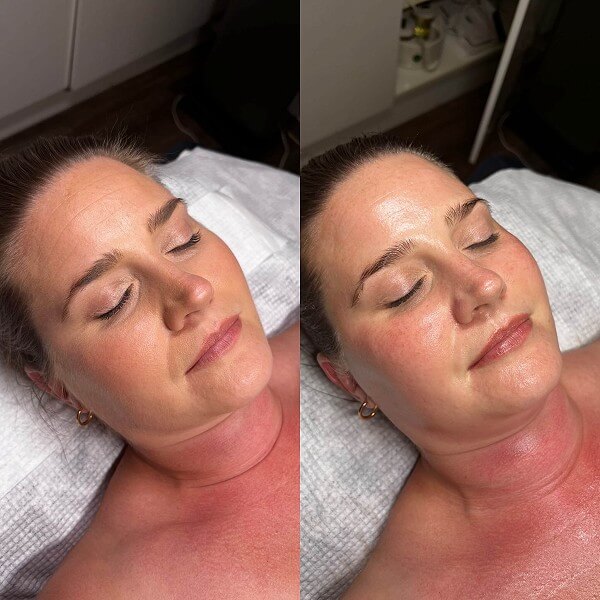 Extraction facial before and after