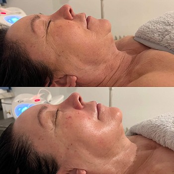Why should you have a Skincare Consultation?