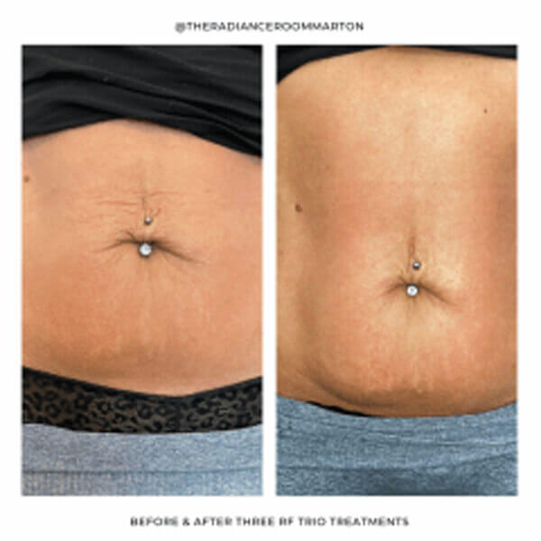 RADIOFREQUENCY STOMACH TIGHTENING