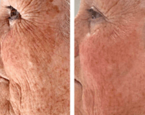 Radiofrequency skin tightening nottingham